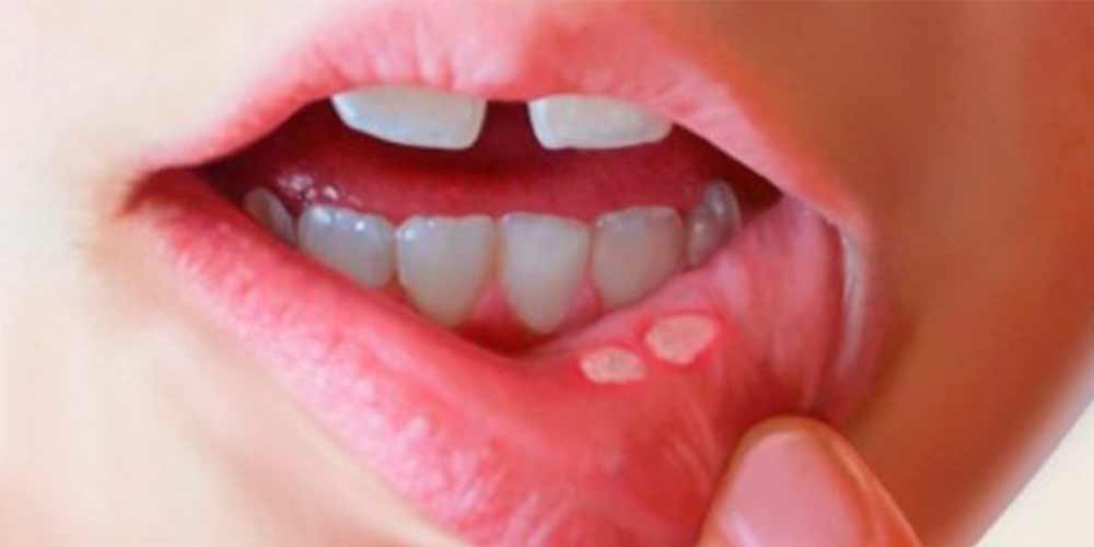 Aftas orales : úlceras bucales, estomatitis aftosa y úlceras aftosas, llagas bucales.