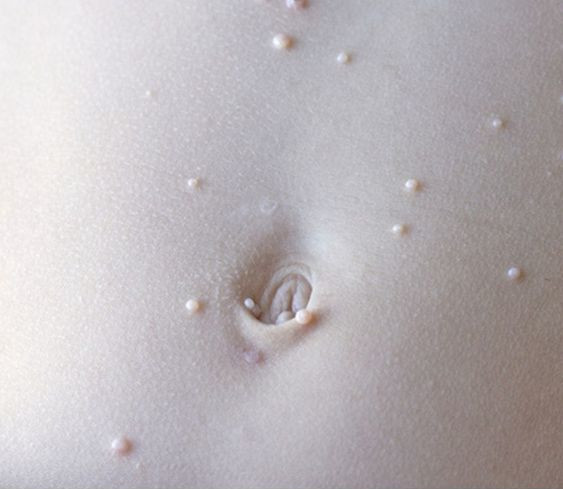 Moluscos contagiosos: 