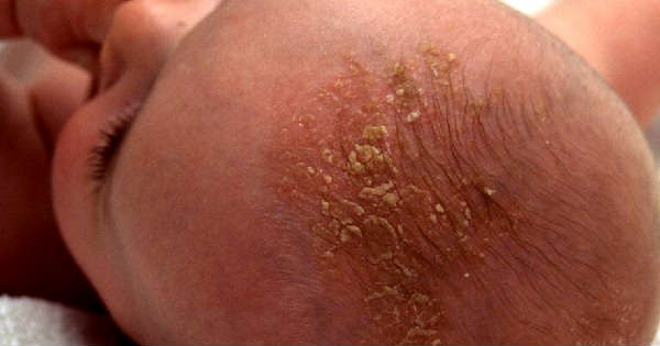 Dermatitis seborreica infantil: costra láctea, dermatitis seborreica en niños.  