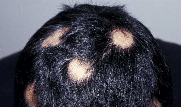 Alopecia areata: Caída del pelo en parches