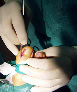 Matricectomía parcial: Cirugía de uñas encarnadas