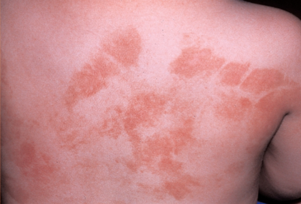 Fitofotodermatitis: Dermatitis de Berloque, Dermatitis por las plantas y el sol