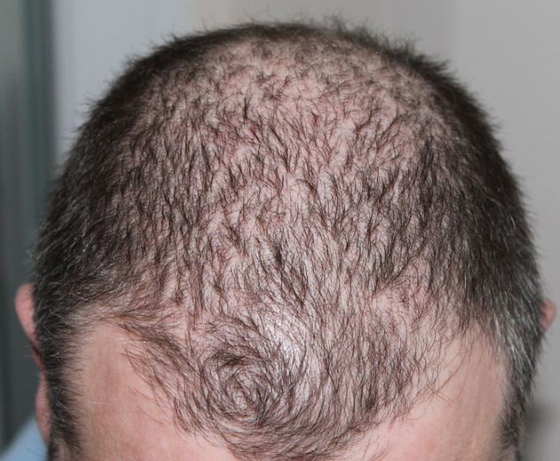 Alopecia Androgénica: Caída del cabello