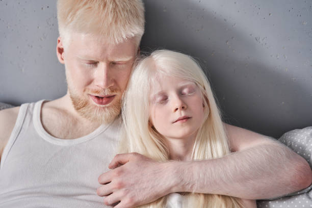 Albinismo: Albinismo oculocutáneo